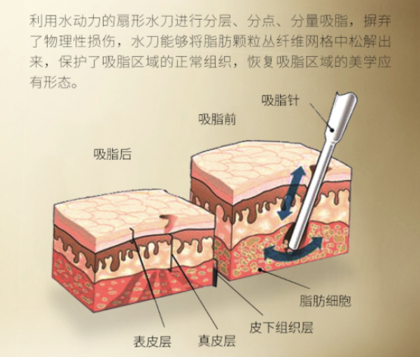 plus会员奢己水动力吸脂单部位