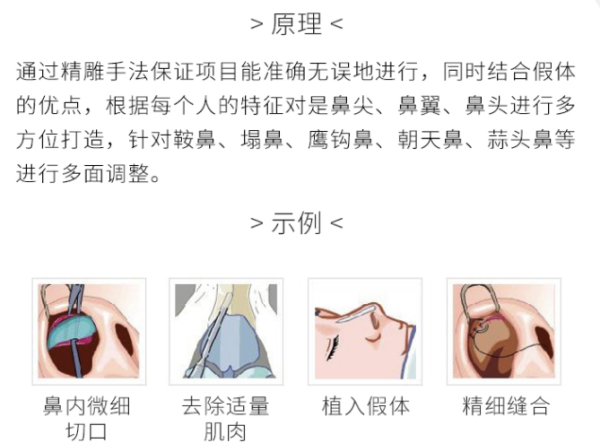 奢己 假体隆鼻 国产硅胶多少钱-什么值得买