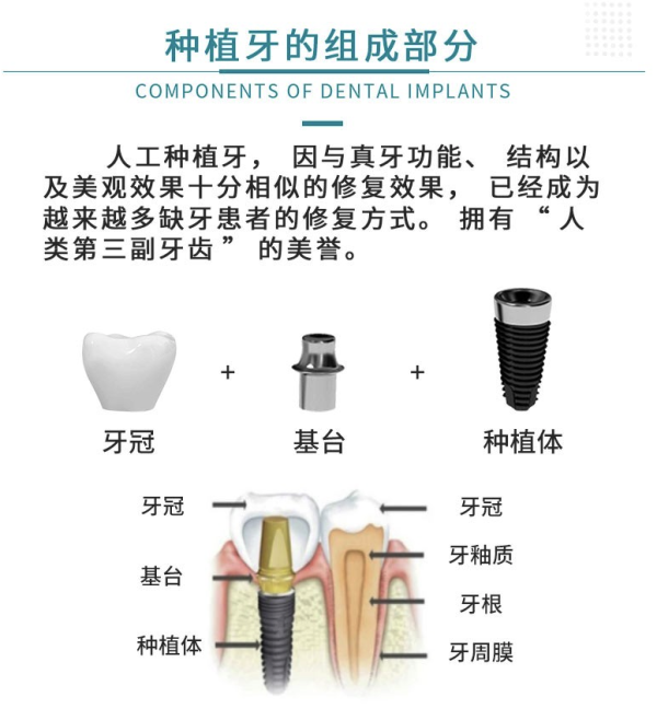 牙管家 美国种植牙1颗