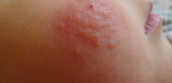 湿疹已经形成红斑，有渗出。