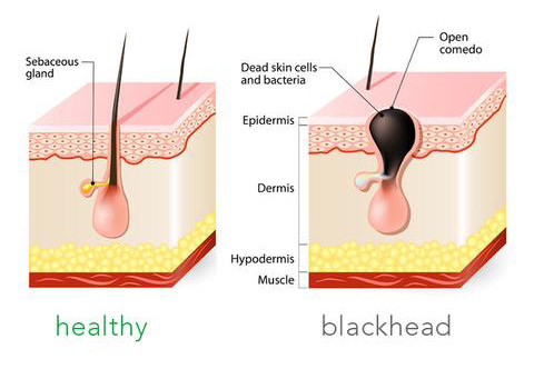 解决密集「孔」惧症!这才是团灭黑头的正确操作