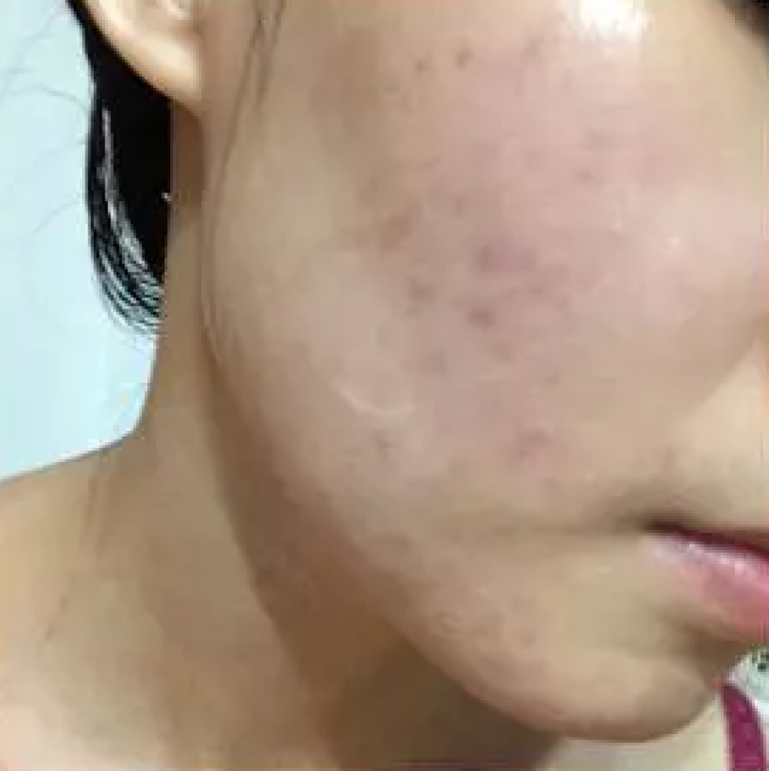 低成本治烂脸攻略：两周见效消闭口淡痘印小经验 | 干货