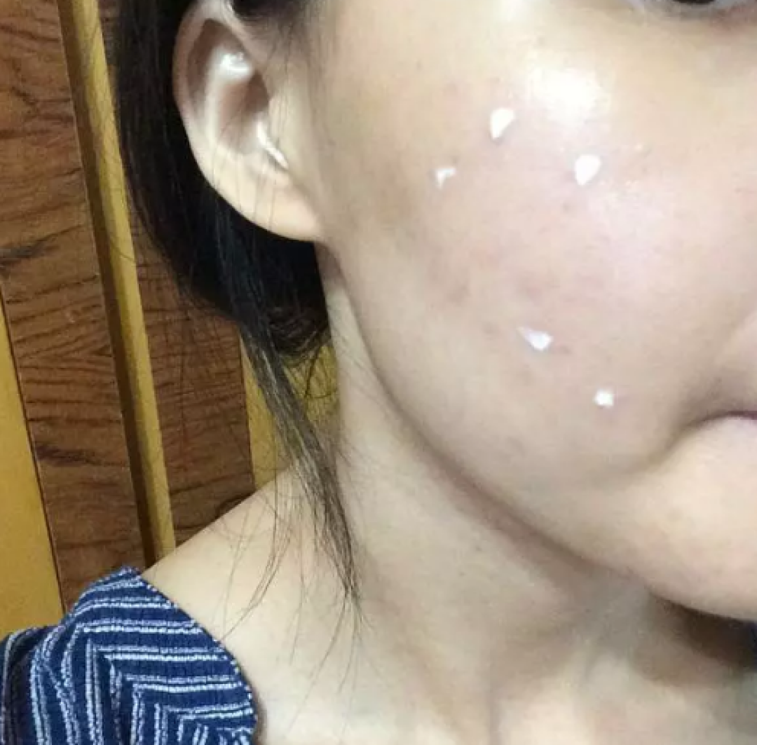 低成本治烂脸攻略：两周见效消闭口淡痘印小经验 | 干货