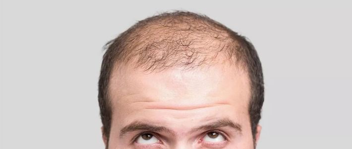  珍爱头发远离“地中海”防脱生发产品推荐榜