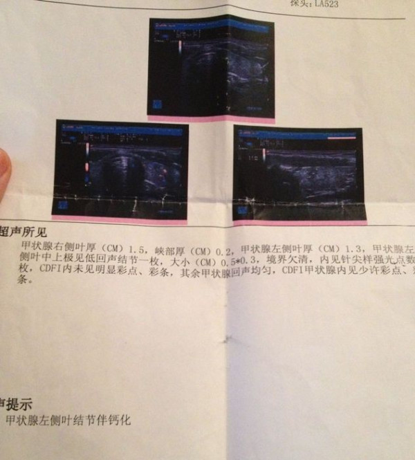 甲状腺结节一定要做手术吗？