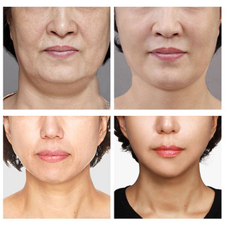 eto/医朵V脸面膜 提拉紧致皮肤 淡化脸部肌肤细纹法令纹 面膜