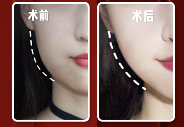 热玛吉项目详解(含适宜人群及副作用介绍)