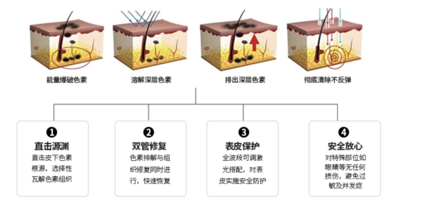 去胎记项目详解(含适宜人群及副作用介绍)