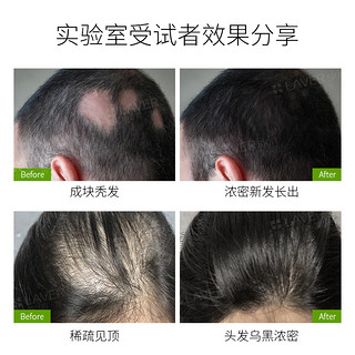 L'AVER 莱薇尔 防脱育发液头发增长液快速生新发脂溢性脱发密发增发营养液