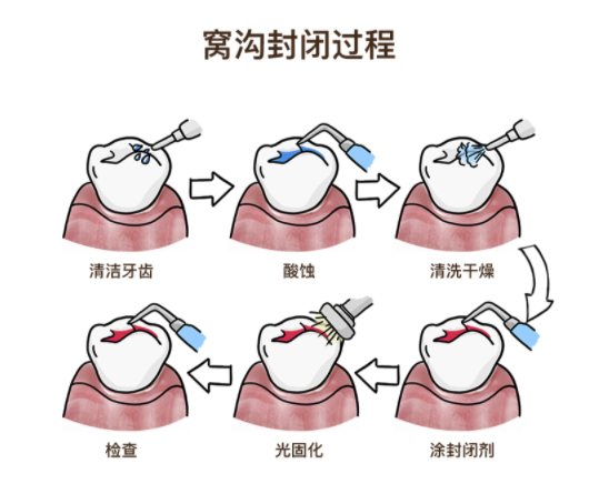 佳美口腔儿童窝沟封闭套餐