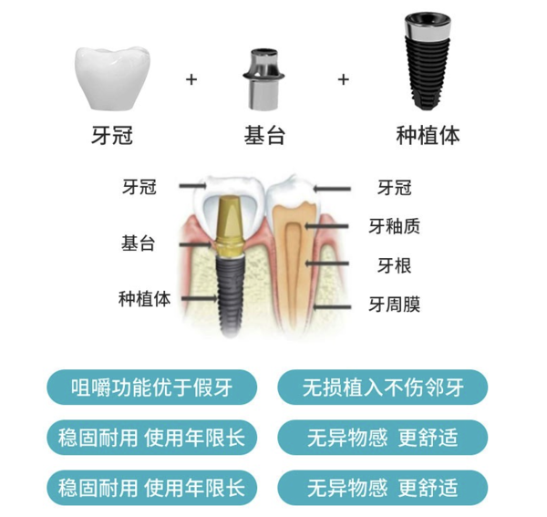 牙管家  北京登腾种植牙1颗