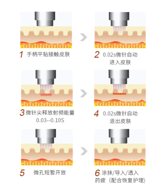 奢己 4D黄金射频微针  1次