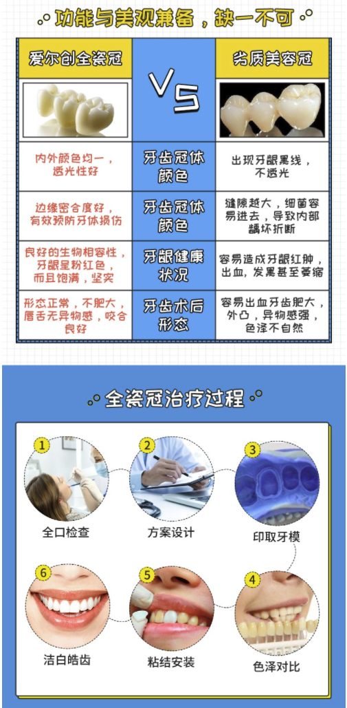 限重庆成都：牙管家  爱尔创全瓷牙冠