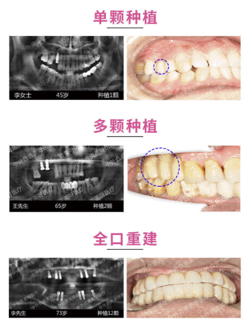 彩虹医生 韩国奥齿泰植牙种植体套餐 进口金属基台