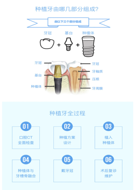 德国进口种植牙套餐 全国通用