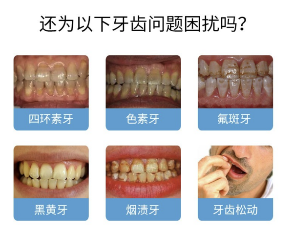 美奥口腔 牙齿美白单次套餐 全国通用