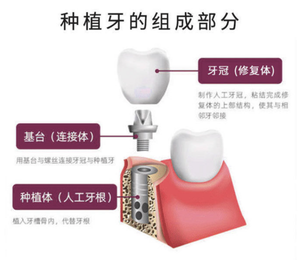 彩虹医生 韩国奥齿泰植牙种植体套餐