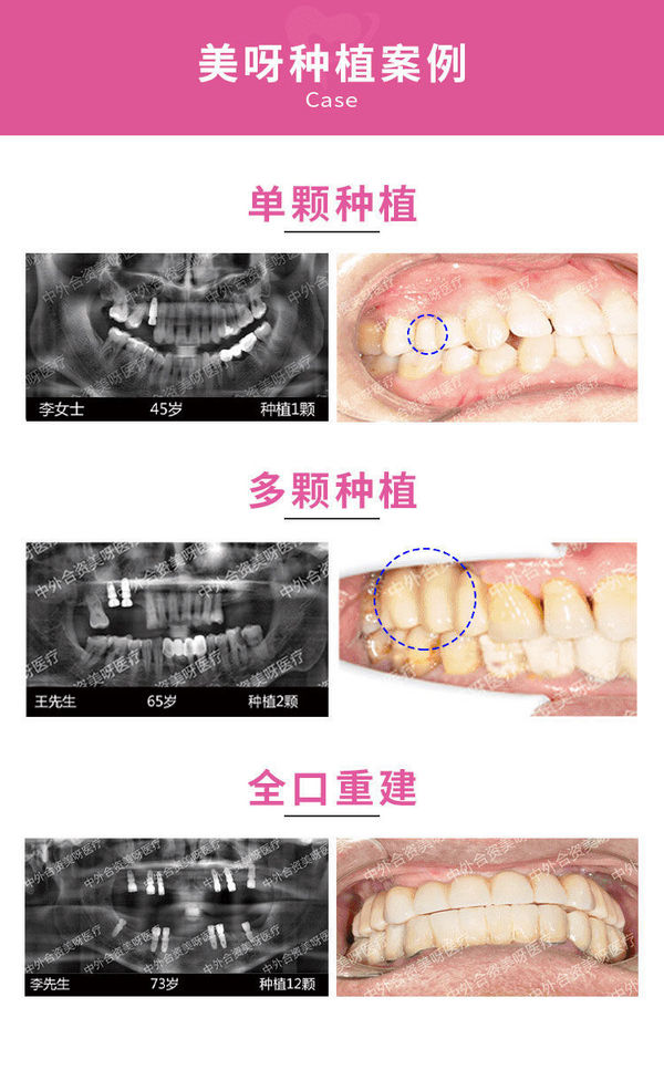 彩虹医生 韩国奥齿泰植牙种植体套餐