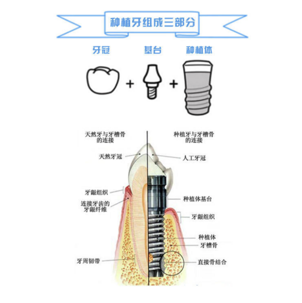 美可普 韩国登腾种植牙套餐