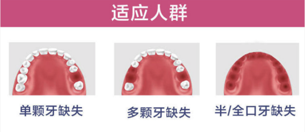 限地区：彩虹医生 半口全口活动种植牙