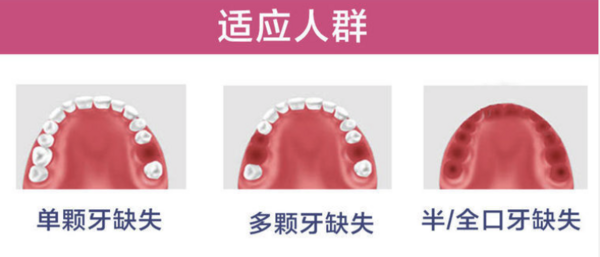 彩虹医生 全口半口固定种植牙