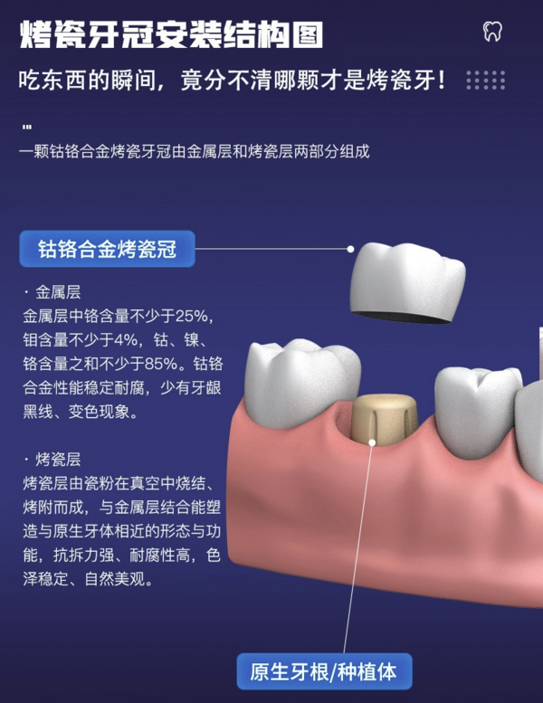 美奥口腔 钴铬合金牙冠1颗