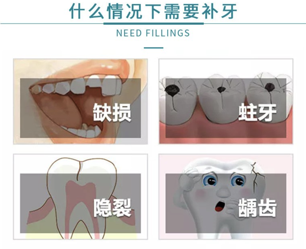 限地区：牙管家 美国3M纳米树脂补牙