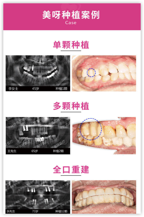 彩虹医生 瑞士ITI士卓曼植牙种植体套餐