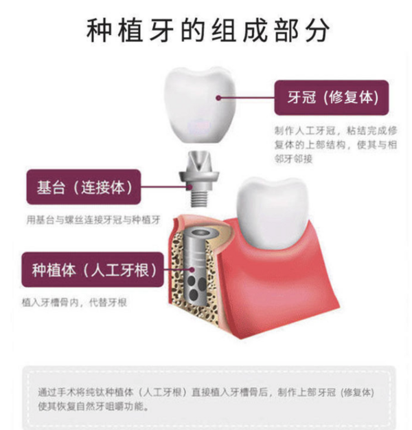 彩虹医生 韩国奥齿泰植牙种植体套餐