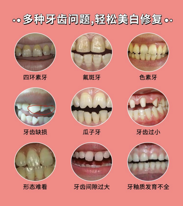 限地区：牙管家 牙齿超薄瓷贴面4颗