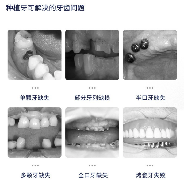 美奥口腔 诺贝尔种植牙套餐+烤瓷冠