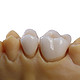 Dalek 戴立克 德国二氧化锆烤瓷牙全瓷牙套镶牙补牙缺牙美容牙齿贴面种植牙冠