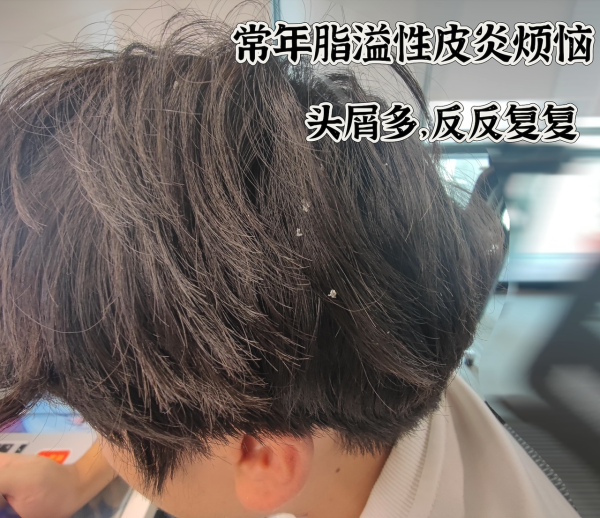 头屑头油严重,大量脱发,用999旭发二硫化硒