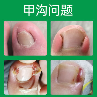  Dr.JYS 甲沟炎 医用凝胶  1盒