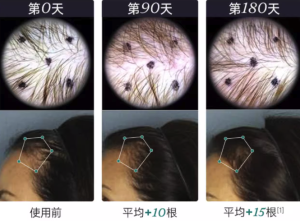 NUTRAFOL 养发黄金胶囊 120粒 明星同款 男女区分脱发食补