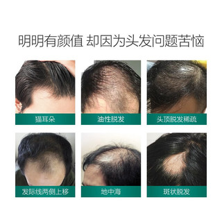  ZHANGGUANG101/章光101 防脱发育发 育发液  160ml
