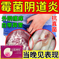 中大 霉菌性阴炎内用药克霉唑栓剂霉菌性瘙痒症异味白带多妇科炎症药妇科专用药阴道用药 1盒