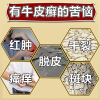 牛皮癣特疗效药 体癣治牛皮癣的特专效用药牛皮癣真菌止痒药膏抑菌皮肤 皮肤用药 硝酸咪康唑乳膏 1本品+1疗癣卡西甫散【内服外用组合治疗】 医用级更放心