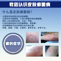 兆誉隆 疗癣卡西甫散10g*16袋燥湿止痒瘙痒银屑病牛皮癣口服药