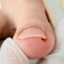 「工具一客一消毒」嵌甲水晶矫正（单指）仅限女宾